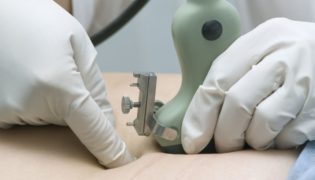 Was ist eine Chorionzottenbiopsie